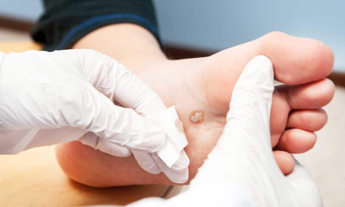 Plantar Wart