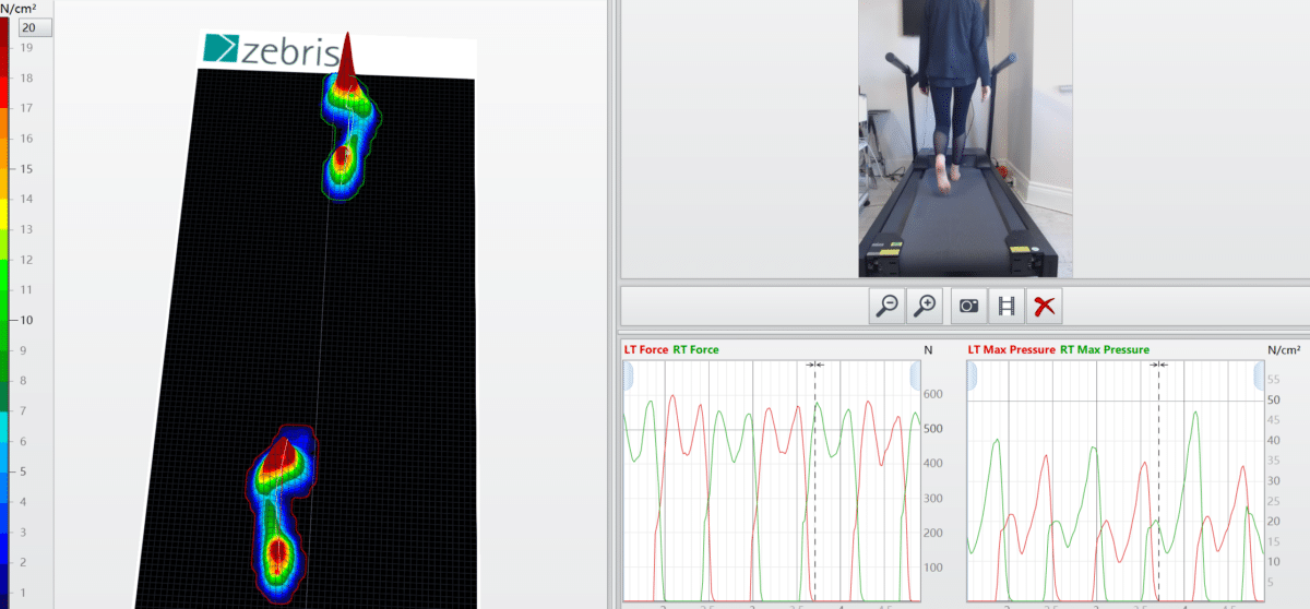 Zebris treadmill pressure analysis screenshot showing heat map of foot pressure distribution, with red and orange colours indicating areas of high pressure beneath the ball of the foot and big toe joint, alongside force and maximum pressure graphs comparing left and right feet.